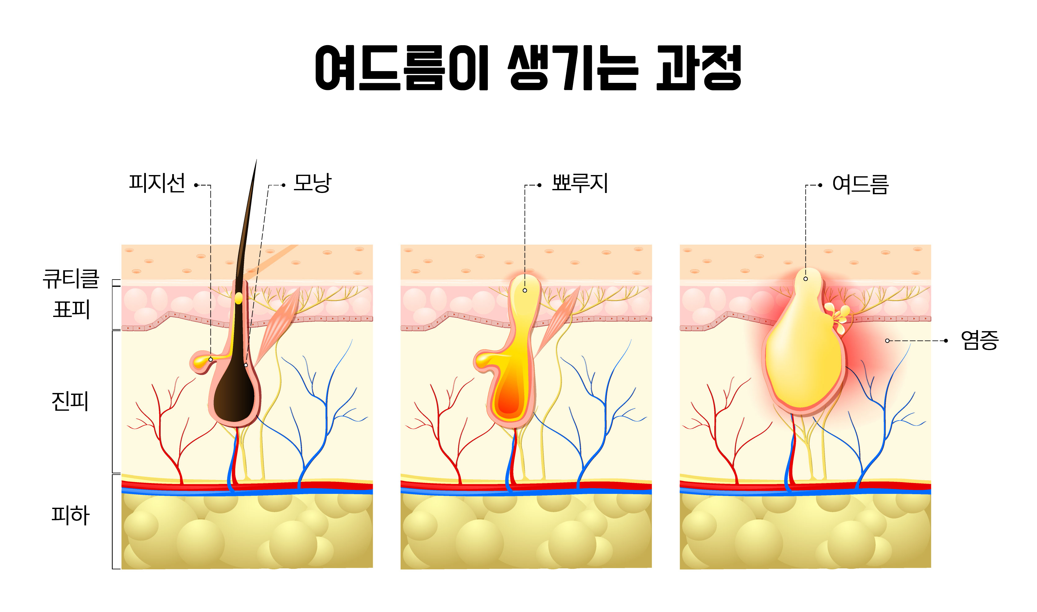 여드름이생기는과정